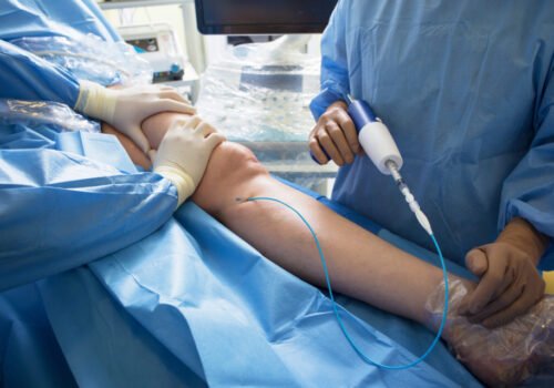 Doctors doing vein surgery procedure