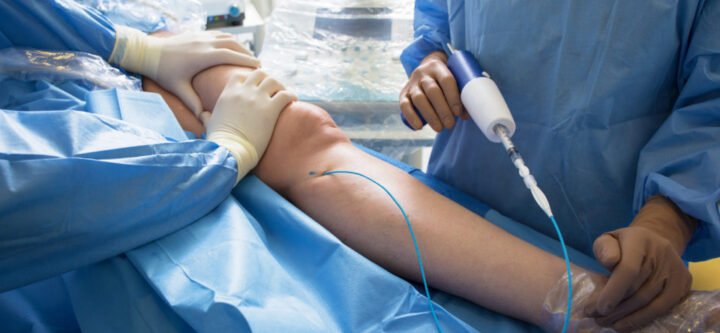 Doctors doing vein surgery procedure