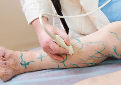 Varicose-Veins