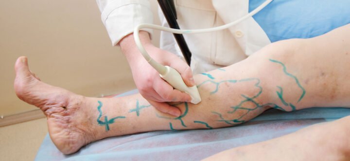 Varicose-Veins